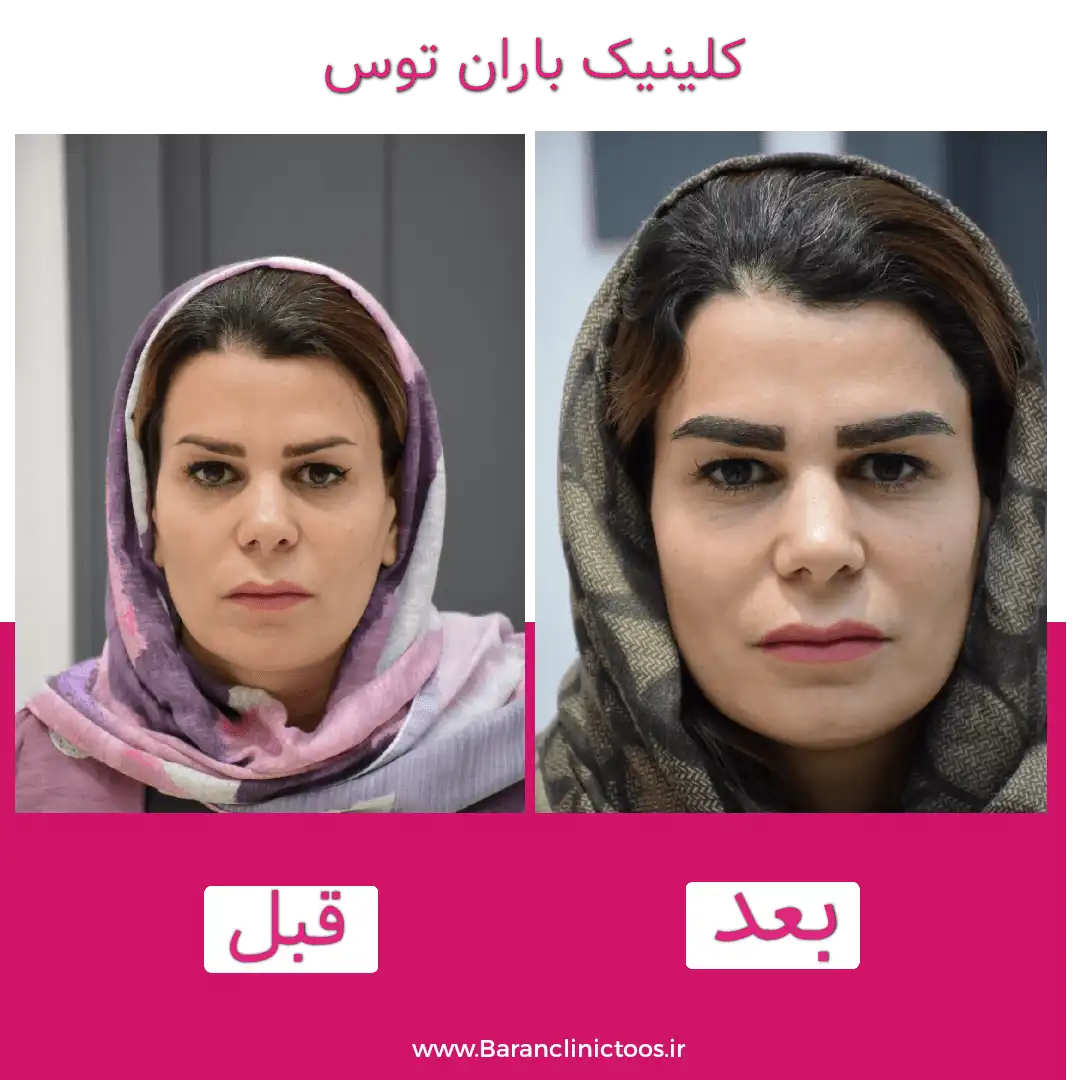 قبل و بعد کاشت ابرو در کلینیک باران توس مشهد